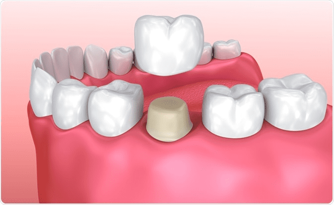 Valley Stream Dental Crowns