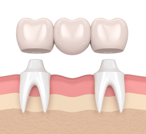 Valley Stream Dental Bridges