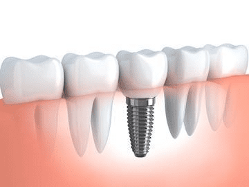 Valley Stream Dental Implants