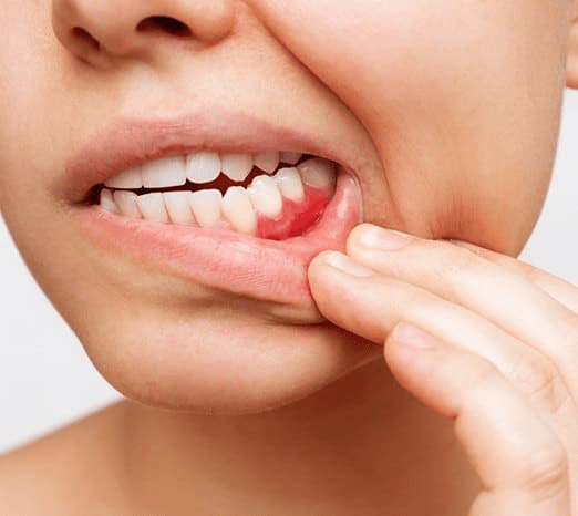 Valley Stream Gum Disease Treatment